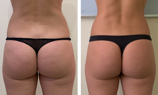 фото до и после роликового массажа