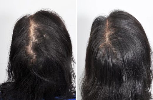 плазмолифтинг для волос фото до и после