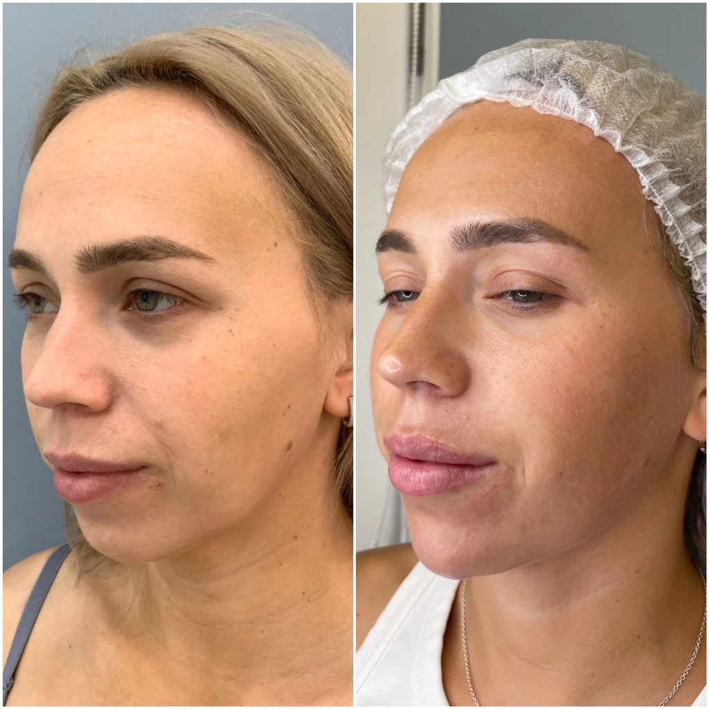 Пример подтяжки кожи лица без операции в клинике Beauty Season