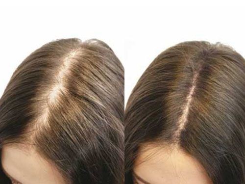 мезотерапия для волос до и после