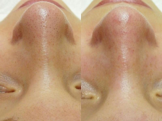 чистка лица у косметолога до и после фото